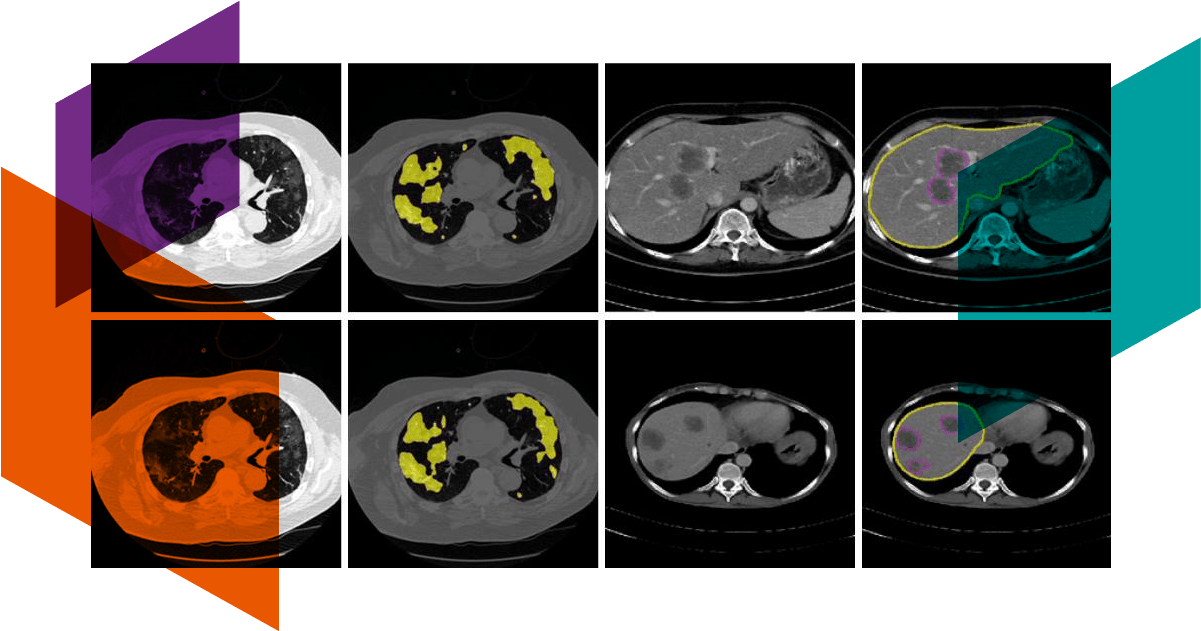 Radiomics disease detection